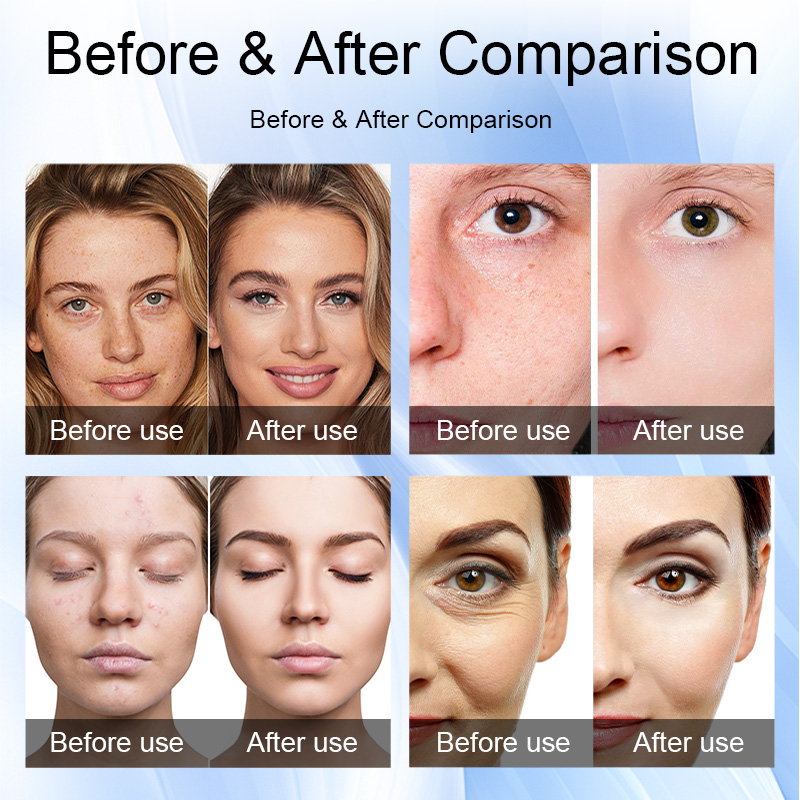 3Professional Nano Mesotherapy Sprayer for Skin Rejuvenation